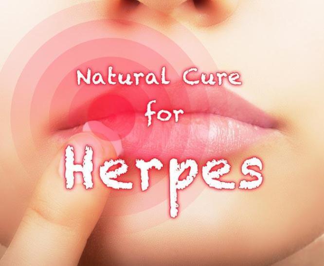 Natural cure For Herpes